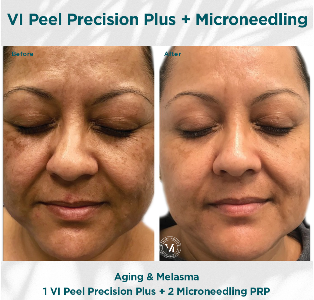 Vi peel precision plus chemical peel kit
