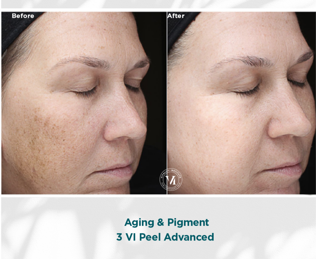 Vi peel precision plus chemical peel kit