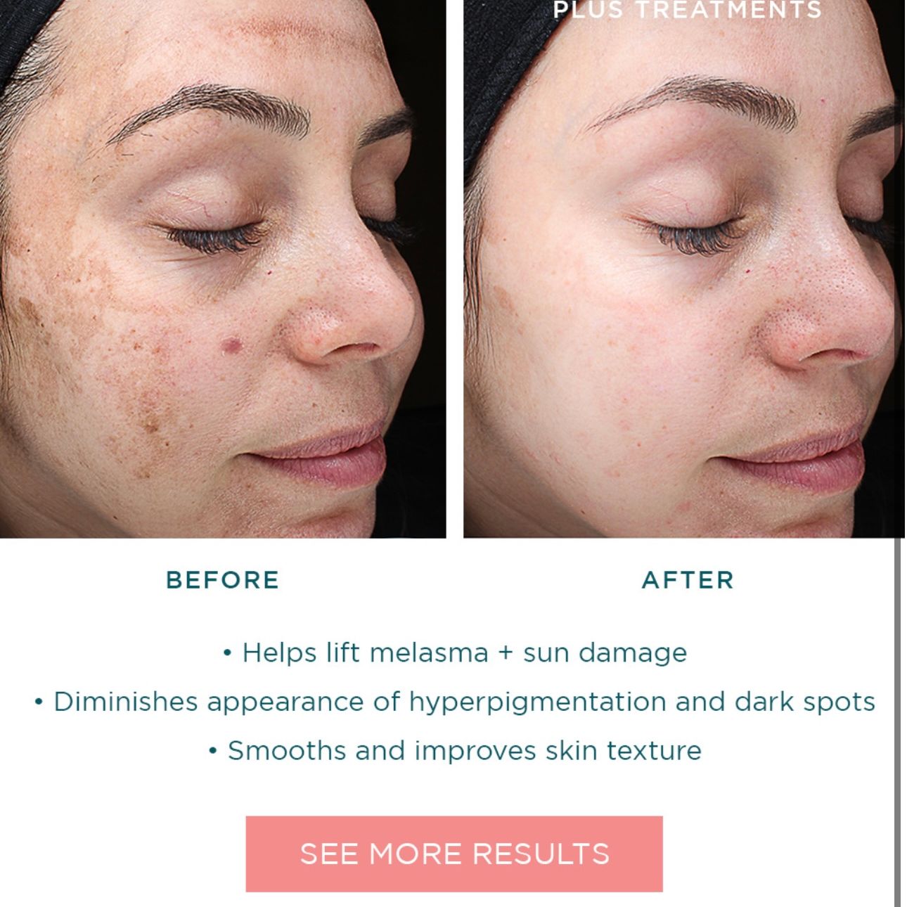 VI Peel Precision Plus