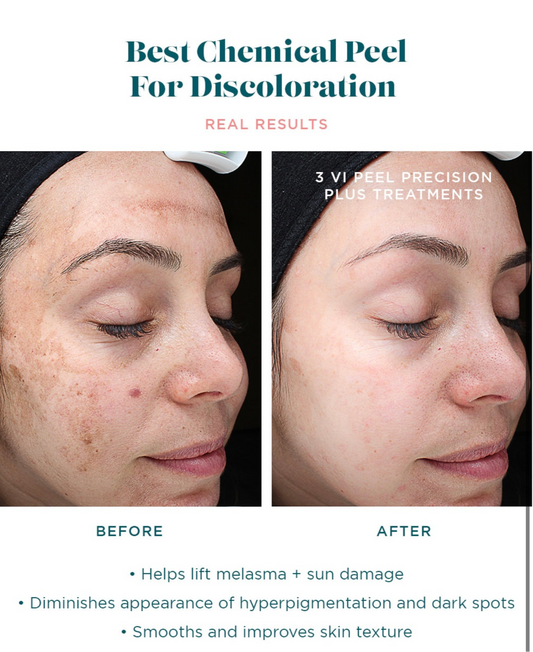 Vi peel precision plus chemical peel kit