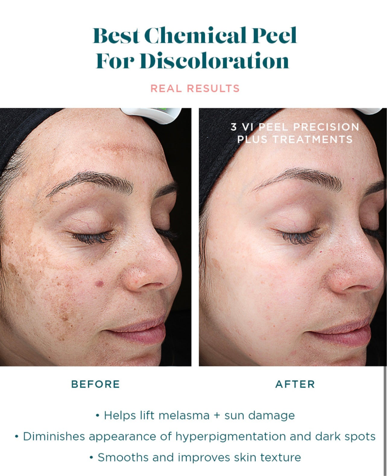 Vi peel precision plus chemical peel kit