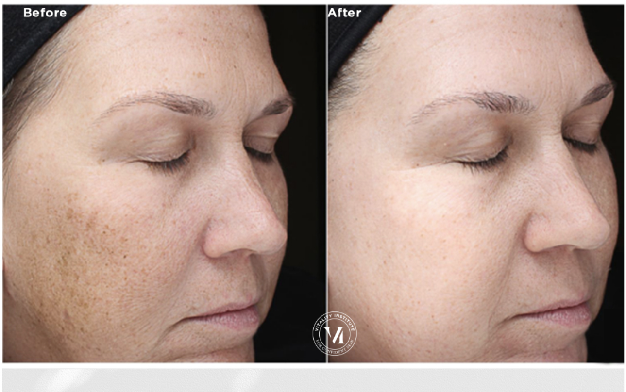 Vi peel precision plus chemical peel kit