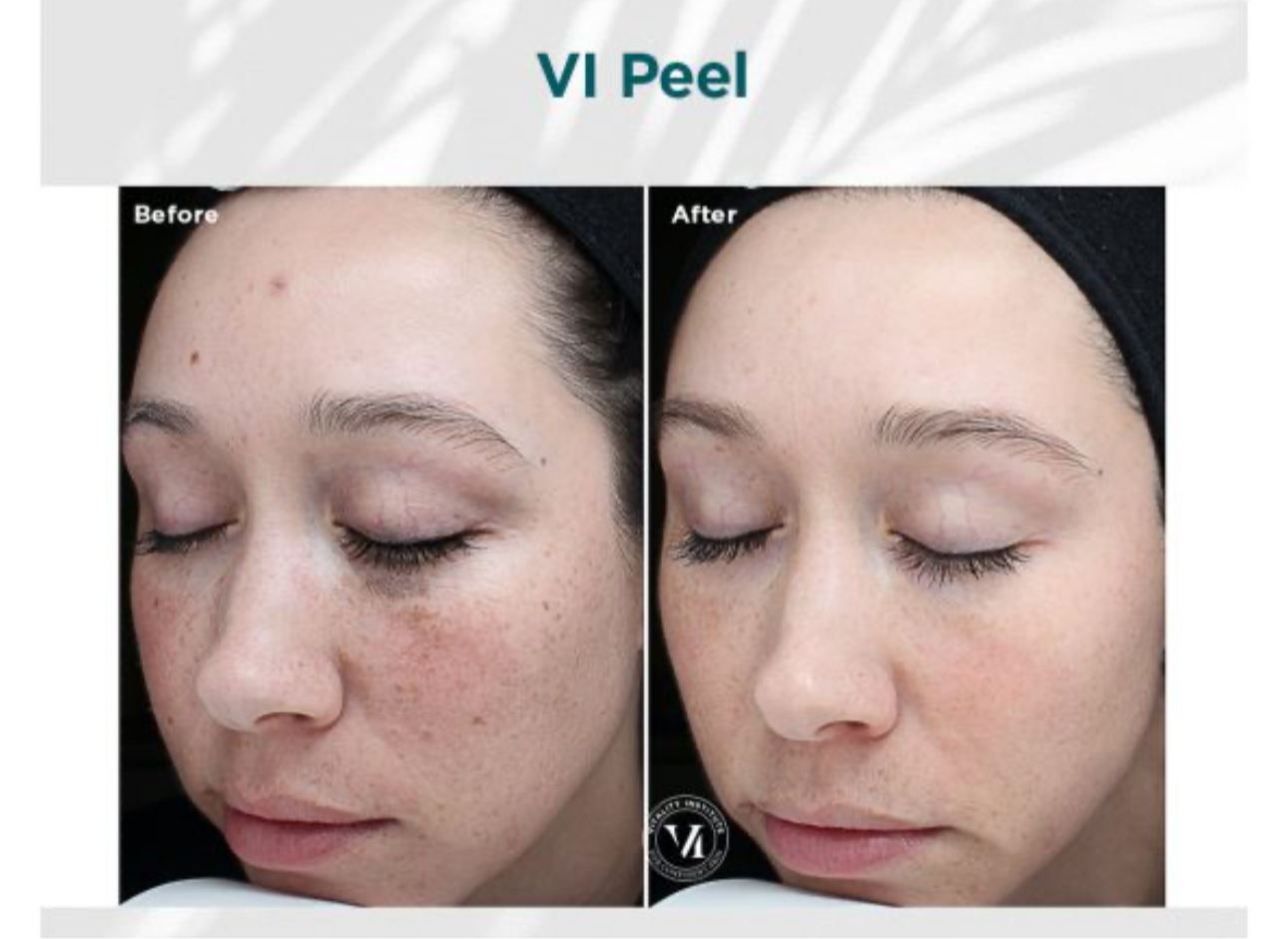 Vi peel precision plus chemical peel kit