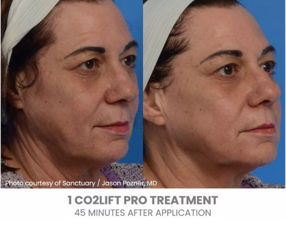 CO2 Lift Pro Carboxy Mask