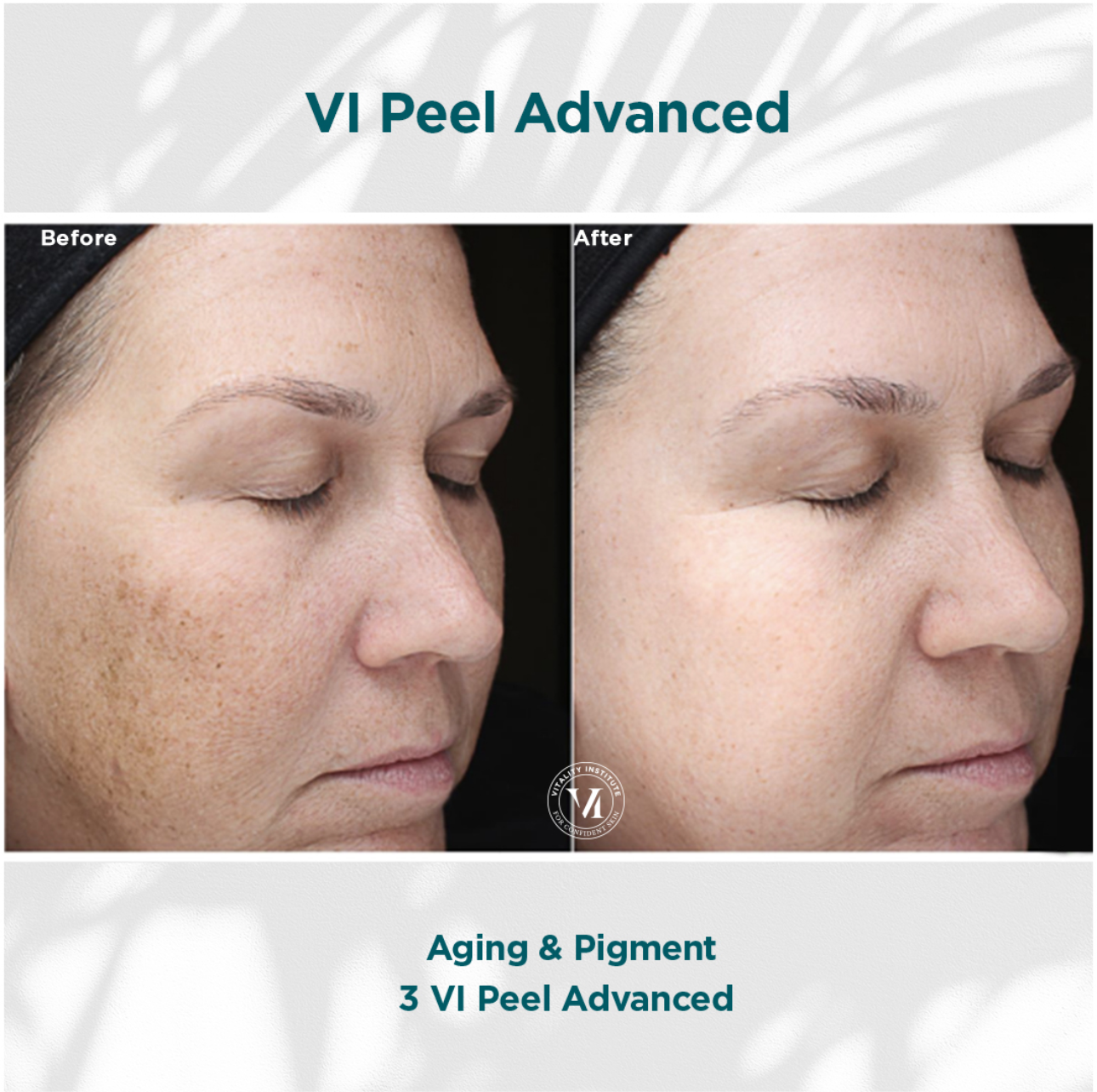 VI Peel Advanced Professional Treatment Chemical Peel
