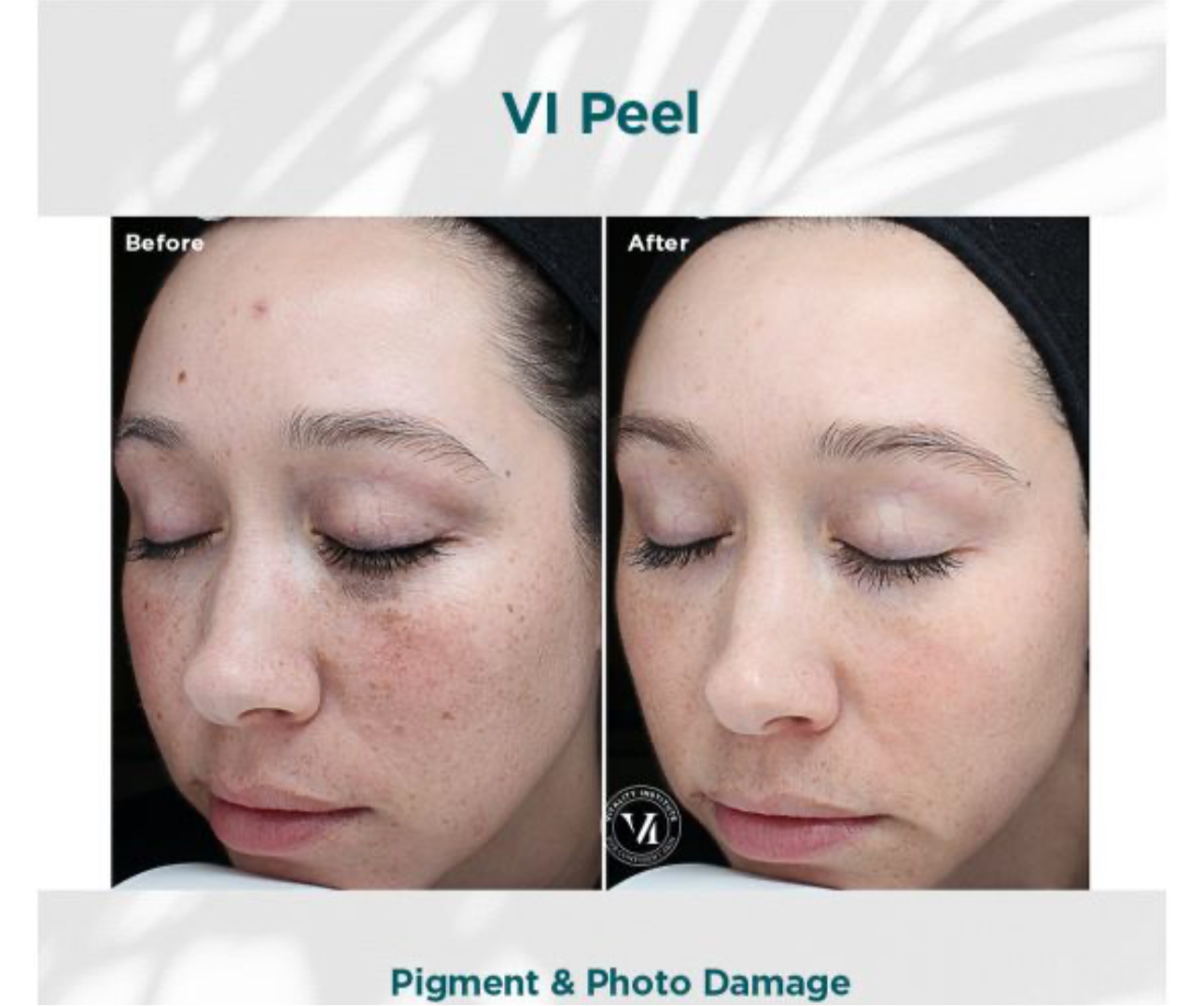 Vi peel precision plus chemical peel kit