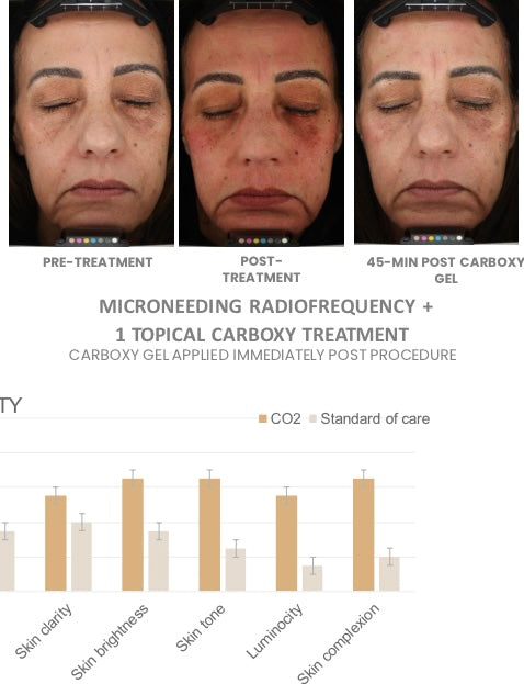 CO2 Lift Pro Carboxy Mask