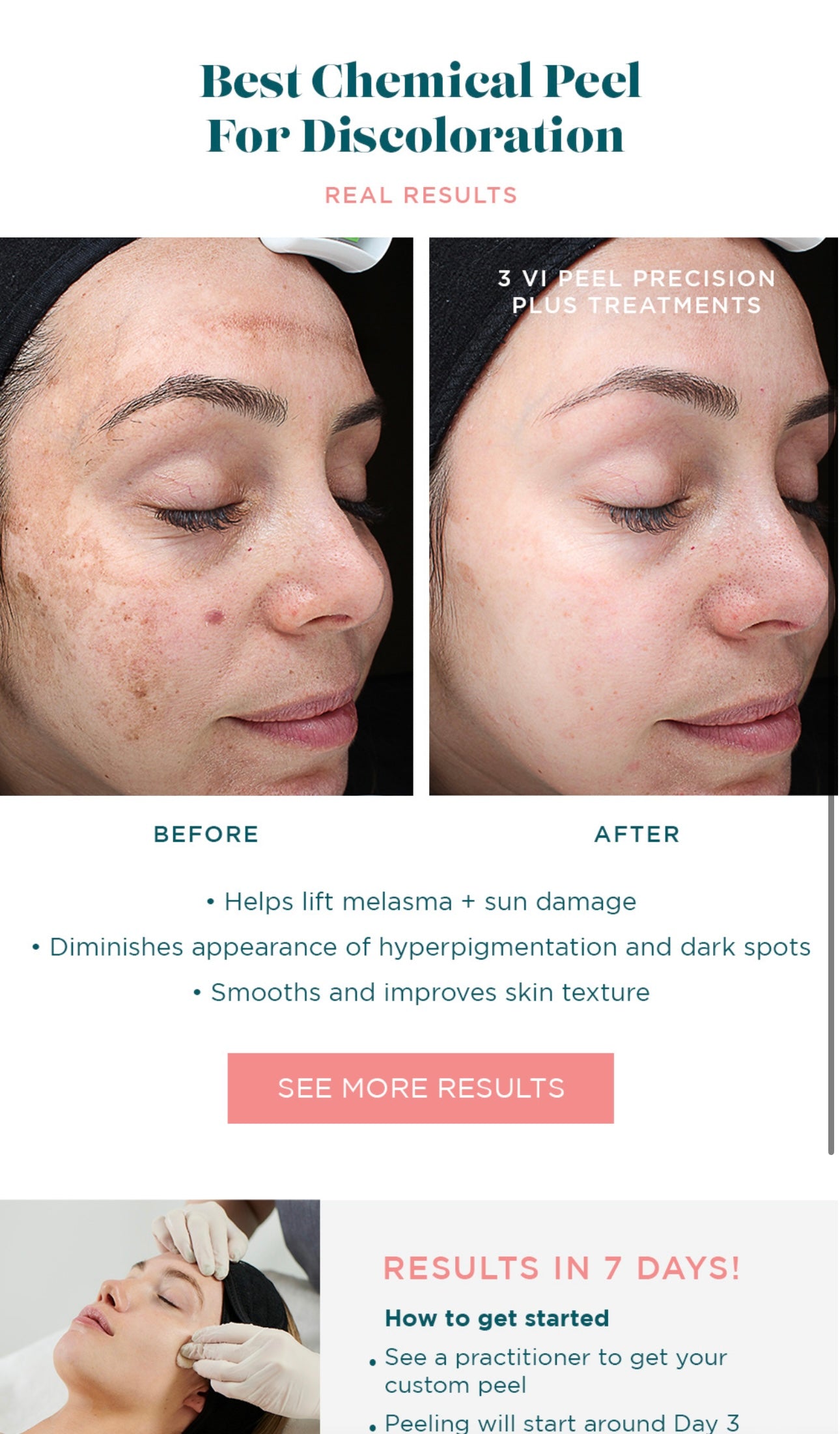 Vi peel precision plus chemical peel kit