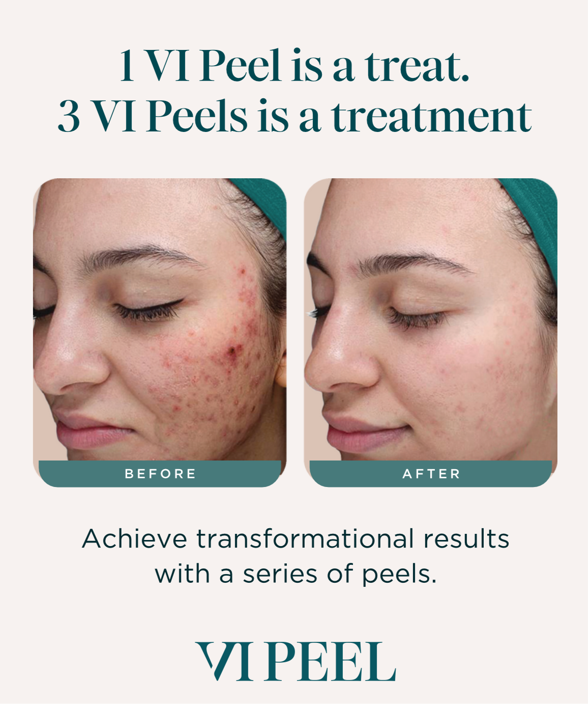 Vi peel precision plus chemical peel kit
